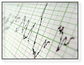 ECG